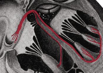 Dual-chamber ICDs fail to offer benefit over single chamber ICDs