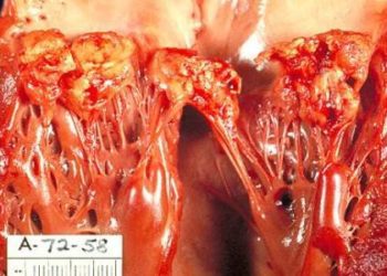 Early weight gain linked to obesity and cardiovascular health