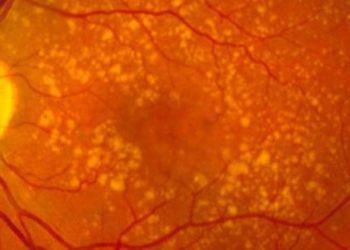 Antioxidants, omega-3 lack benefit in age-related macular degeneration