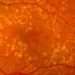 Antioxidants, omega-3 lack benefit in age-related macular degeneration