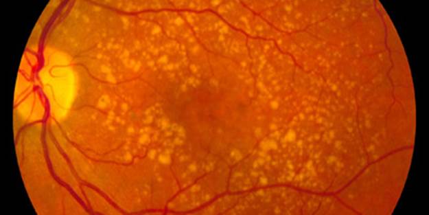 Intermediate_age_related_macular_degeneration