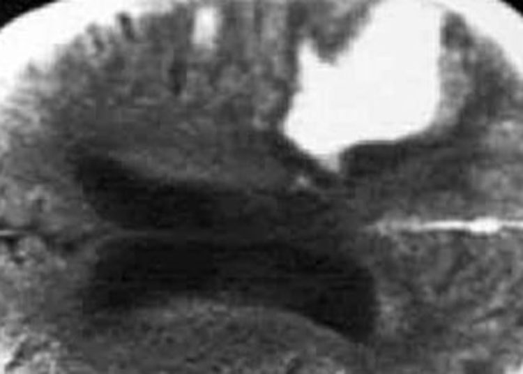 Aggressive blood pressure control may be beneficial for intracerebral hemorrhage [INTERACT2]
