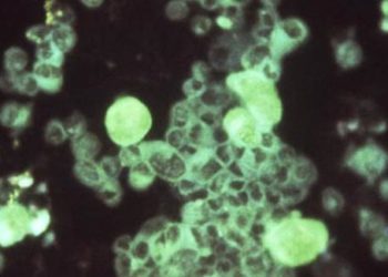 Untreated breast milk linked to CMV transmission