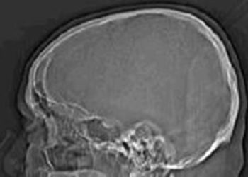 Brain injuries linked with increased military suicide risk