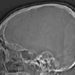 Brain injuries linked with increased military suicide risk