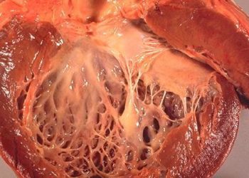 Antidepressant may reduce mental stress-induced myocardial ischemia (REMIT Trial)