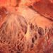 Antidepressant may reduce mental stress-induced myocardial ischemia (REMIT Trial)