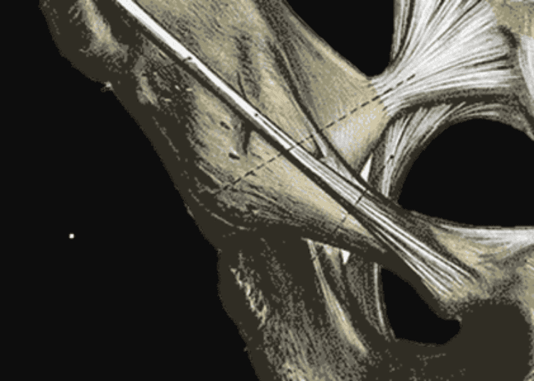 Pelvic organ prolapse surgery has increasing complications long-term