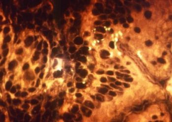 Key pathogens burden diarrhea in the developing world