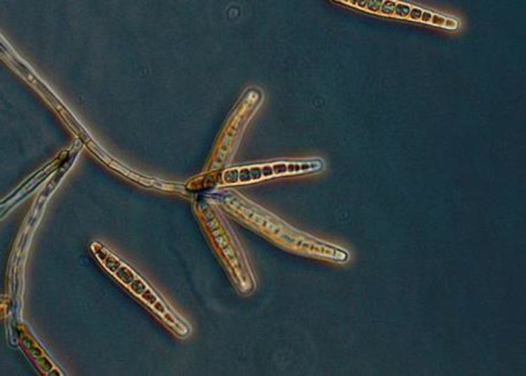 MRI screening for fungal infection from methylprednisone injections