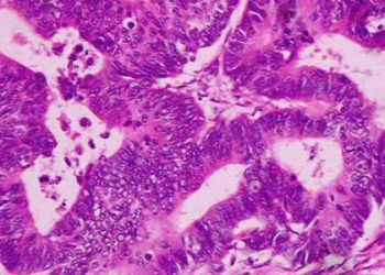 Neoadjunctive radiotherapy, hospital factors key for rectal cancer resection