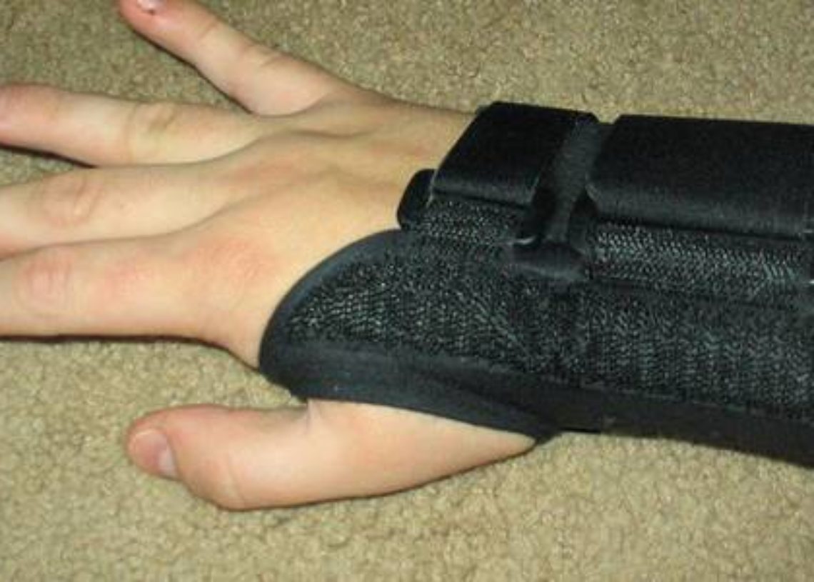 Steroid injections in carpal tunnel syndrome reduce symptom severity 2 Minute Medicine