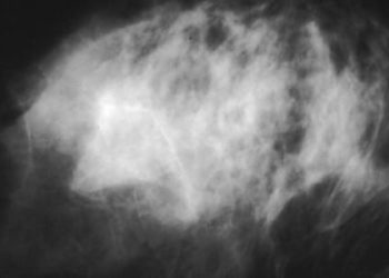 Intake of fish fatty acids associated with lower risk of breast cancer