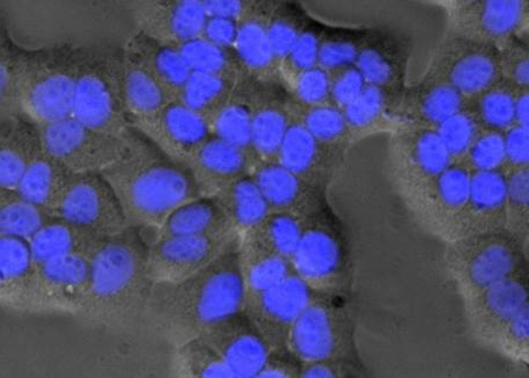 A marker of aggressive liver cancer and potential therapeutic target identified