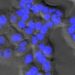 A marker of aggressive liver cancer and potential therapeutic target identified