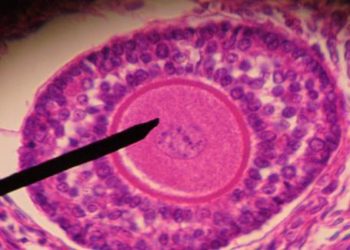 Oral glucose tolerance test preferred for pre-diabetes screening in PCOS