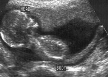 Mortality risk associated with low-birth weight