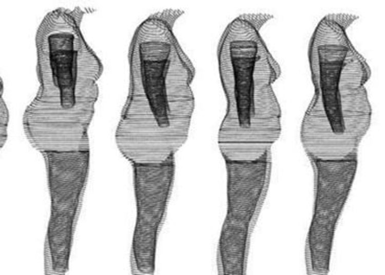 Bariatric surgery is an effective option for weight loss and glycemic control