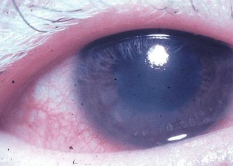 Interferon therapy is superior to methotrexate for uveitis