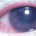 Interferon therapy is superior to methotrexate for uveitis