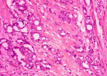 Soy supplementation does not reduce risk of prostate cancer recurrence