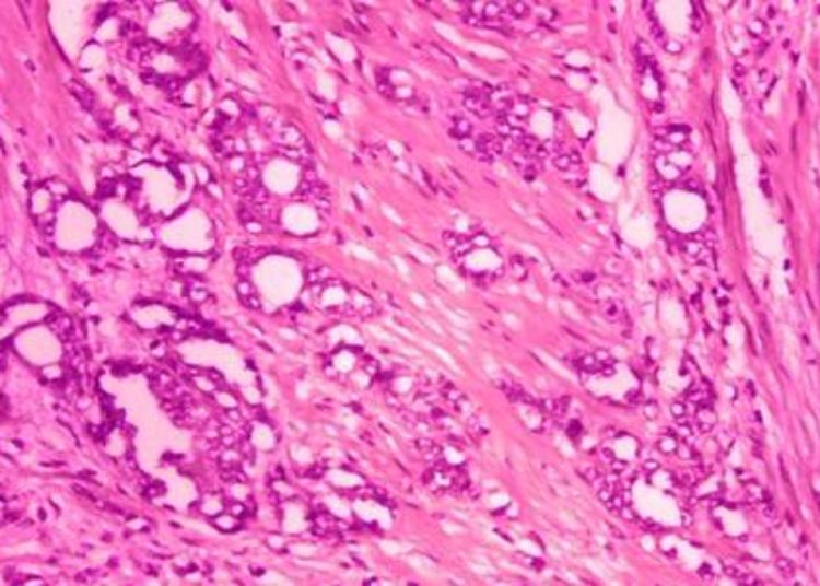 Soy supplementation does not reduce risk of prostate cancer recurrence