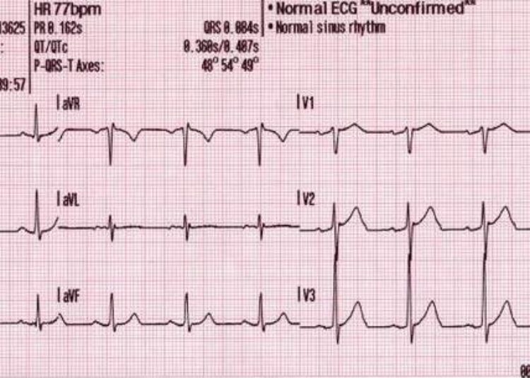 Preterm delivery associated with long-term maternal cardiovascular risk