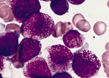 Alternative treatment for acute promyelocytic leukemia promising