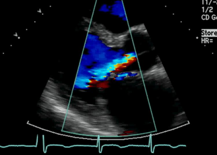 Echocardiographic screening does not improve all-cause mortality