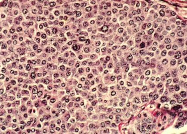 One-year of Herceptin preferable to two-year regimen