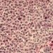 One-year of Herceptin preferable to two-year regimen
