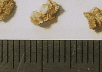 Renal stones in women linked with increased risk of coronary heart disease