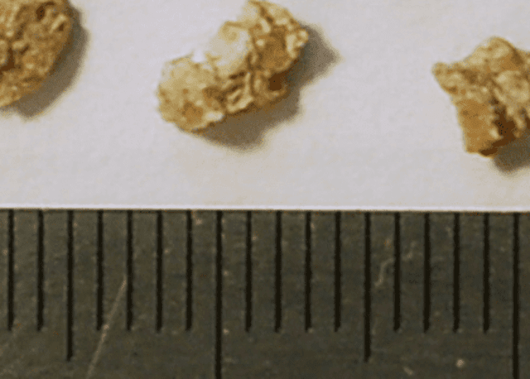 Renal stones in women linked with increased risk of coronary heart disease