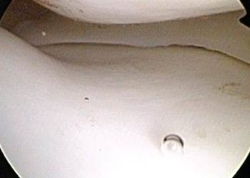 Recent surgery, operative times increase complications of knee arthroscopy
