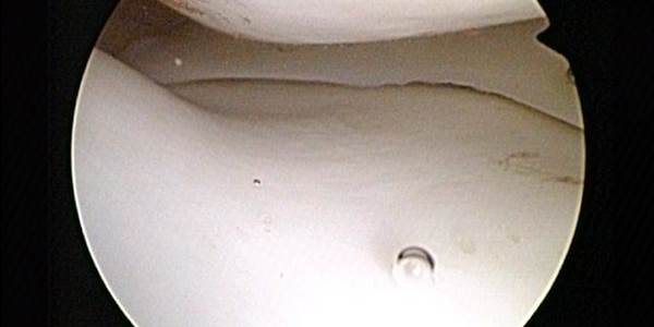 Normal_medial_meniscus