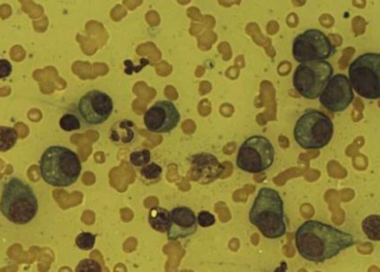 Phase III trial shows survival benefit for early multiple myeloma