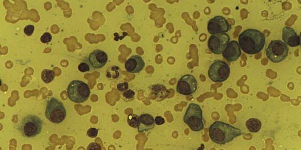 Plasma_Cells_in_Multiple_Myeloma_patient