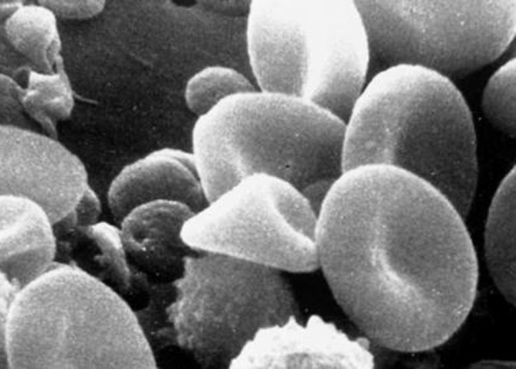 New genetic link in pulmonary arterial hypertension holds therapeutic promise