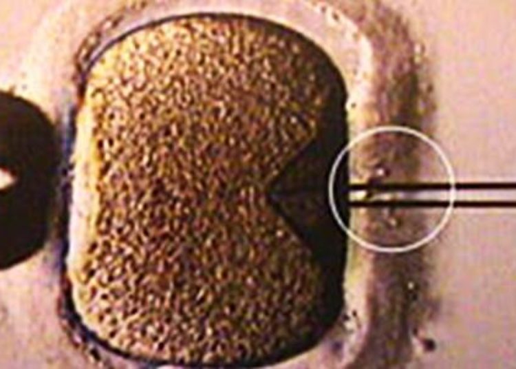 Severe endometriosis associated with poor IVF outcomes