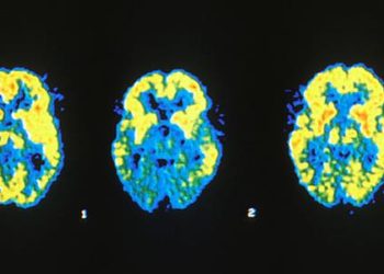 Dementia prevalence declining in the UK