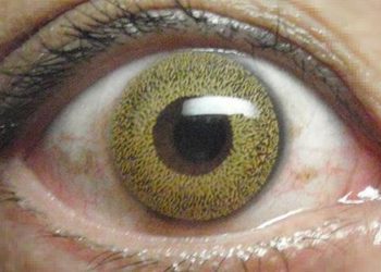 Blindness and visual impairment decreasing worldwide