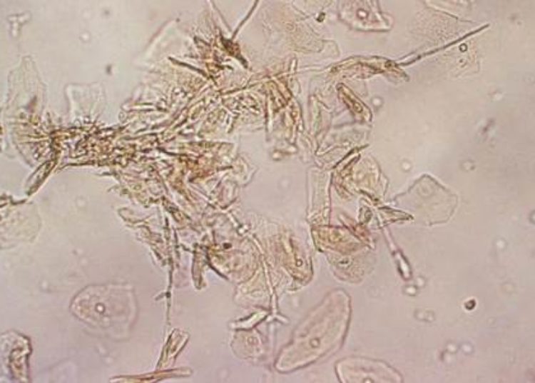 Fluconazole in first trimester not associated with increase in most birth defects