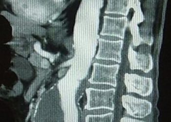 Fruit consumption linked to lower risk of abdominal aortic aneurysms