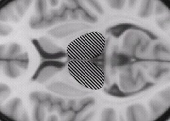 MRI-guided ultrasound thalamotomy may reduce essential tremor