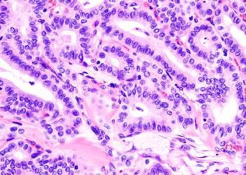 Three ultrasonographic findings portend increased risk of malignancy in thyroid nodules