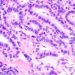 Three ultrasonographic findings portend increased risk of malignancy in thyroid nodules