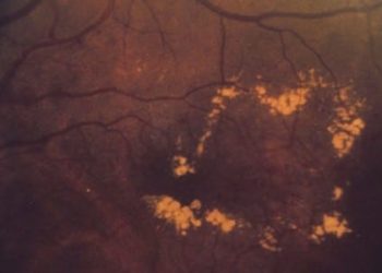 Diabetic patients report improved vision after ranibizumab treatment