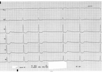 Propofol appears safe and effective in procedural sedation for cardioversion