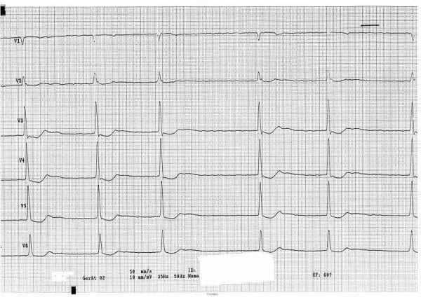 non specific qrs widening ivcd