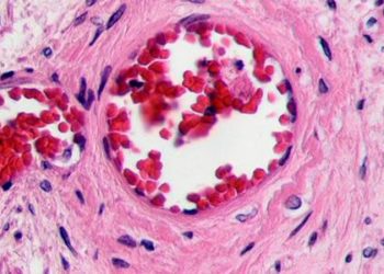 Soaring rates of peripheral artery disease, now over 200 million cases worldwide